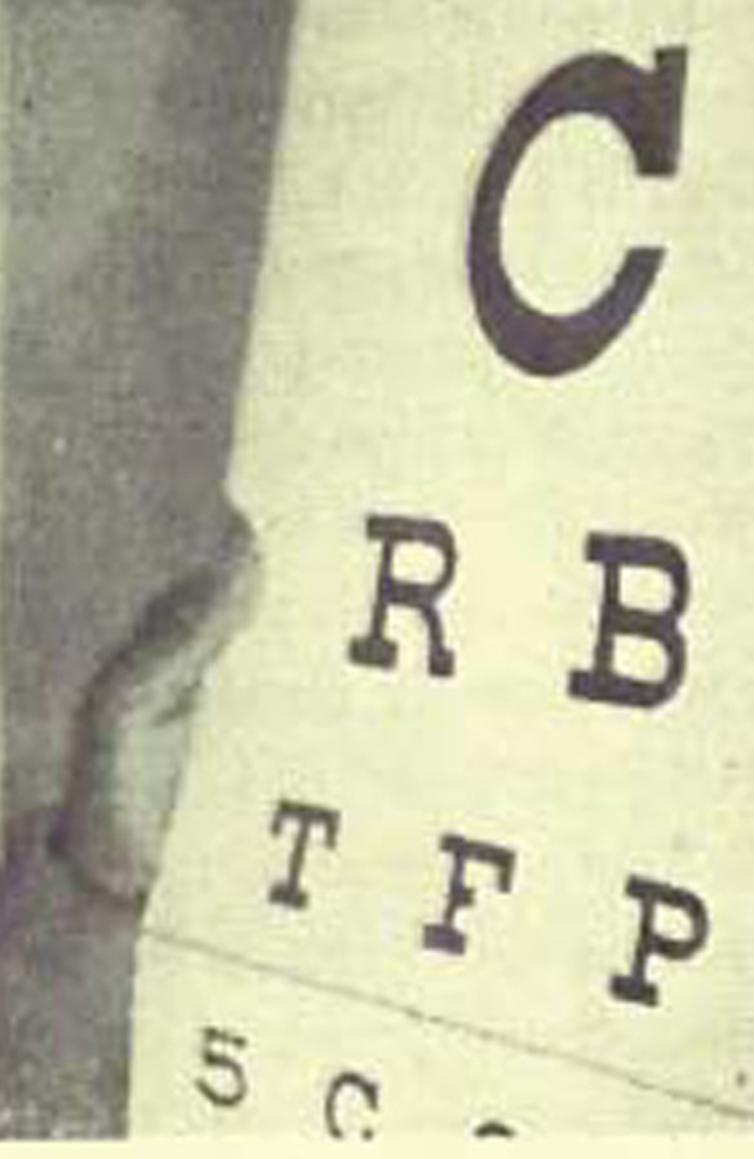 Patient in Dr. Bates Clinic uses Palming and Eyechart to Cure Extreamly Low Vision